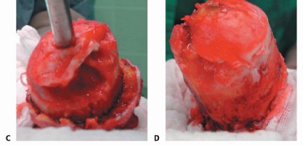 صورة طبية: ترميم مفصل الورك: الحل الأمثل للحفاظ على عظم رأس الفخذ في صنعاء مع الدكتور محمد هطيف