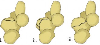 Illustration 2 for Missed Coronoid Fractures? Identify Complex Coronoid Injuries