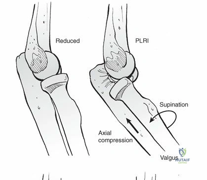 Illustration of elbow dislocation elbow - Dr. Mohammed Hutaif
