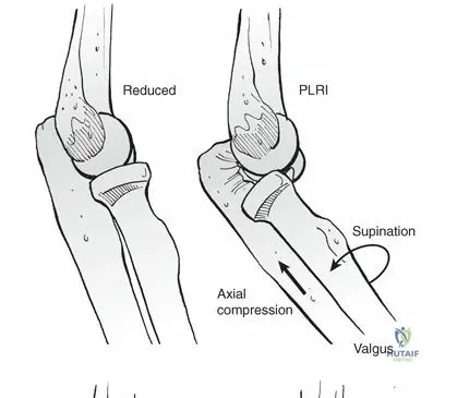 Illustration of elbow dislocation elbow - Dr. Mohammed Hutaif