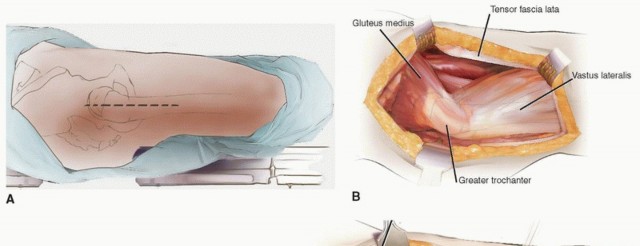 Illustration 30 for Periacetabular Osteotomy: Realigning your hip via the superior pubic ramus