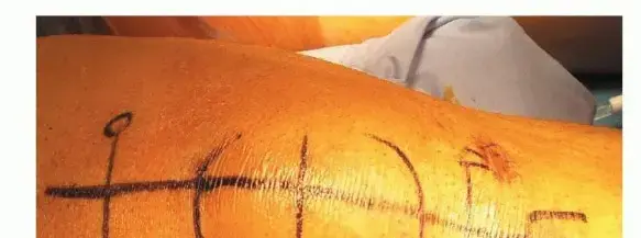 تمزق وتر العضلة الرباعية: دليل شامل للمرضى نحو الشفاء الكامل على يد الأستاذ الدكتور محمد هطيف