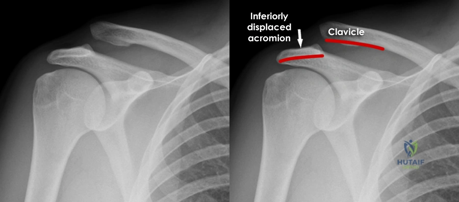 Illustration of acromioclavicular dislocation acromioclavicular - Dr. Mohammed Hutaif