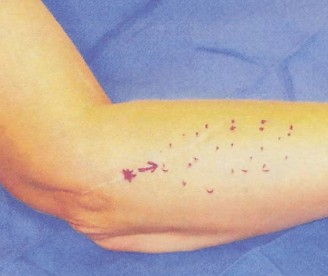 Atypical Elbow Pain: Is Your Extensor Carpi Radialis the Key?