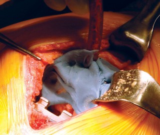 Illustration 35 for Cemented TKA Figure: Your Visual Guide to Surgical Success