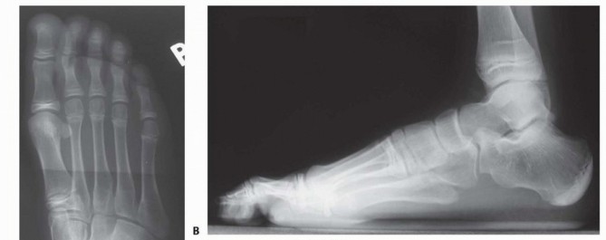 Illustration of excision of talocalcaneal - Dr. Mohammed Hutaif