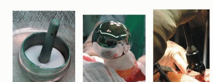 صورة طبية: ترميم مفصل الورك: الحل الأمثل للحفاظ على عظم رأس الفخذ في صنعاء مع الدكتور محمد هطيف