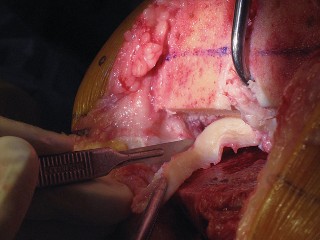 Illustration 32 for Posterior Stabilized Technique: Essential Insights for TKA Success