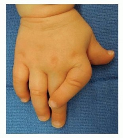 Finger Curving: What is Clinodactyly?