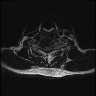 Illustration 3 for Adjacent Segment Degeneration: Your Next Spine Case Solved