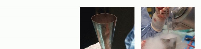 صورة توضيحية لـ تجنب الجراحة الكبرى: علاج أورام العظام بالنيتروجين السائل بتقنية الصب المباشر