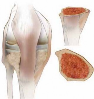 Guide Pin Assembly: Key to Flawless Upper Tibial Osteotomy