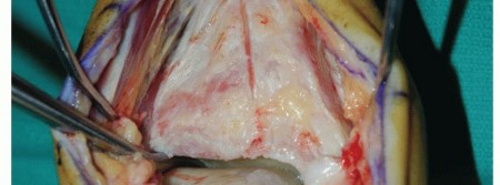 Illustration 26 for Unlock Healing: Medial Malleolar Osteotomy for Talus OLT Allografts