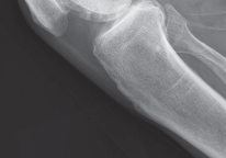 Illustration 5 for Minimize Pain, Maximize Recovery: TKA with Parapatellar