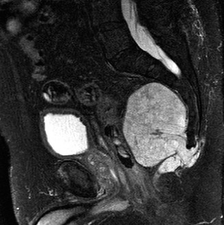 Illustration of oncology cases chordoma - Dr. Mohammed Hutaif