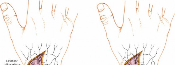 Illustration 19 for Essential Surgical Approaches: Uncover Every Aspect of the Wrist