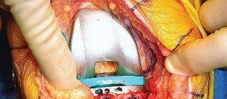 Illustration 54 for Mastering TKA: Essential Methods of Rotational Alignment
