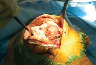 Illustration 13 for Optimize Tibial Component Alignment: Techniques for TKA Success