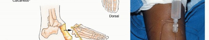 صورة طبية: أورام القدم: دليلك الشامل للعلاج، البتر، والاستئصال مع الأستاذ الدكتور محمد هطيف في صنعاء