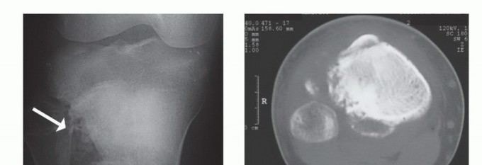 صورة طبية: معالجة الأورام المعقدة في قصبة الساق القريبة حلول الحفاظ على الأطراف