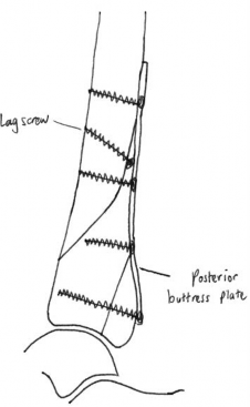 Illustration 19 for Decoding Pilon Fractures: Anterolateral and Medial Fragments Revealed