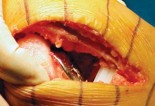 Illustration 64 for Knee Arthroplasty: Avoiding Pitfalls & Benefiting from UKA