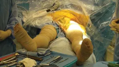 صورة توضيحية لـ المقاربة الأمامية لاستبدال مفصل الورك الكلي: دليل شامل للتعافي السريع مع الأستاذ الدكتور محمد هطيف في صنعاء