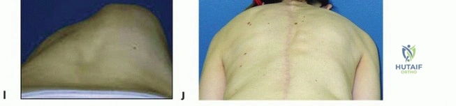 صورة توضيحية لـ كسر عظمة الترقوة: دليل شامل للعلاج والتعافي مع الأستاذ الدكتور محمد هطيف