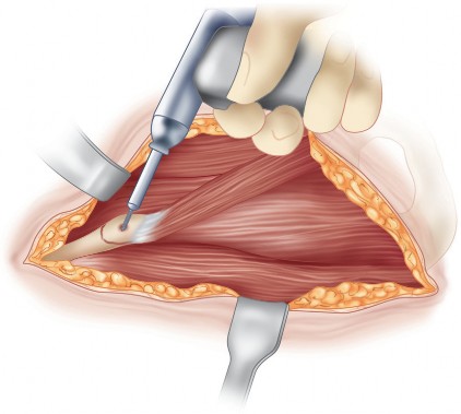 Illustration 68 for Bernese PAO: Unlocking the Procedure with Level V Evidence Insights