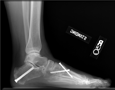 Illustration 111 for First Metatarsal Surgery: Expert Solutions for Foot & Ankle Pain