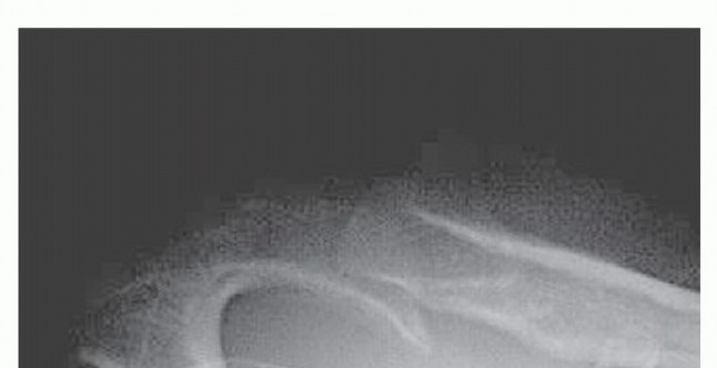 Find Relief: Arthroscopic Subacromial Decompression for Impingement