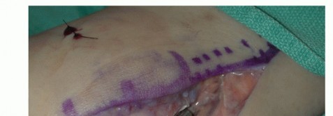 Illustration 36 for Beyond Primary Repair: Solutions for Peroneal Tendon Subluxation