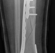 Illustration 18 for Complex Tibial Shaft Fracture: Plate Fixation for Plafond Extension