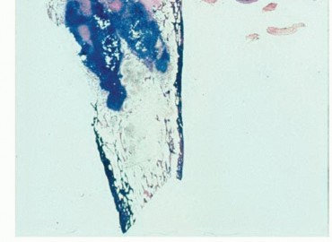 Illustration 10 for Beyond Amputation: Total Femur Resection with Endoprosthetics
