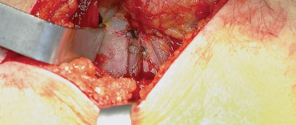 Illustration 17 for Unlock the Figure Posterior Approach to the Hip