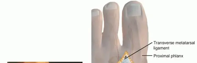 عملية تصحيح ورم إبهام القدم الأروح (الوكعة): دليل شامل لاستعادة راحة قدميك مع الأستاذ الدكتور محمد هطيف