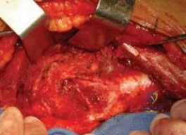 Advanced Degenerative Changes in Untreated FAI