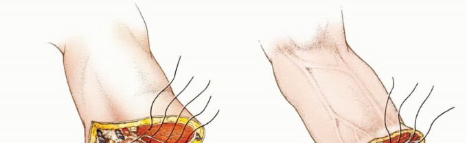 صورة توضيحية لـ بتر الذراع فوق وتحت الكوع: متى ولماذا يصبح ضرورة طبية؟ دليل شامل من الأستاذ الدكتور محمد هطيف