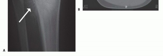 صورة طبية: معالجة الأورام المعقدة في قصبة الساق القريبة حلول الحفاظ على الأطراف