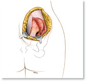 Pelvis & Acetabulum Approaches: Unlocking the Posterior Superior Iliac
