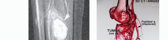 صورة توضيحية لـ استئصال ورم العضلة النعلية: دليل شامل لحماية عضلة الساق والتعافي الكامل في صنعاء مع الأستاذ الدكتور محمد هطيف