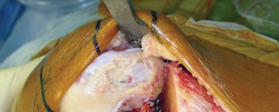 Illustration 15 for Minimize Pain, Maximize Recovery: TKA with Parapatellar