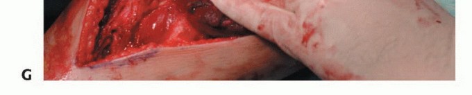 صورة طبية: استئصال أورام الشظية: دليل شامل للعلاج الحديث والحفاظ على الأطراف مع الأستاذ الدكتور محمد هطيف