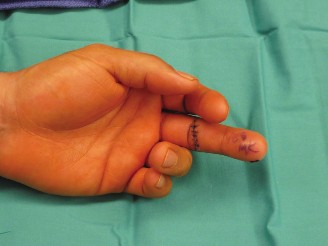 Optimizing Flexor Tendon Repair: Splinting & Rehab Essentials