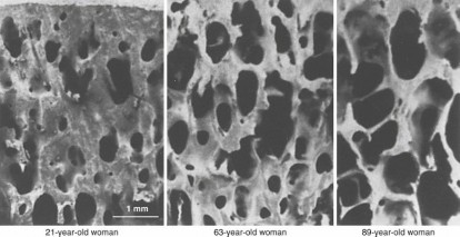 صورة توضيحية لـ إدارة كسور الهشاشة واضطرابات كثافة العظام: دليل شامل للمرضى