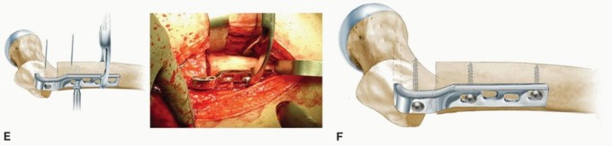 Illustration 34 for Periacetabular Osteotomy: Realigning your hip via the superior pubic ramus