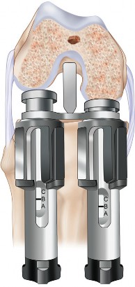 Illustration 47 for Mastering TKA: Essential Methods of Rotational Alignment