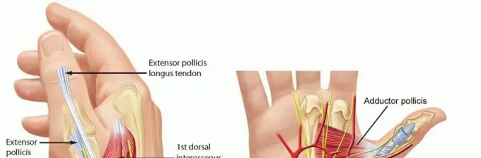 صورة توضيحية لـ خلع مفصل الإبهام وعدم استقراره المزمن: دليل المريض الشامل للتشخيص والعلاج والتعافي
