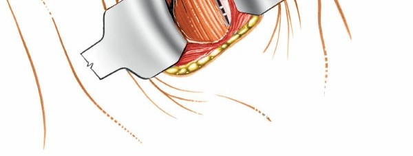 Illustration 17 for Mastering the Anterior Cervical Approach: Longus Colli Muscle Insights