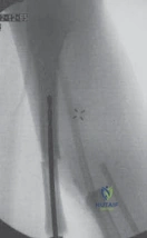 ABOS Part I Orthopedic Spine Review: Scoliosis, Disc Pathology & Radiculopathy Management | Part 22165